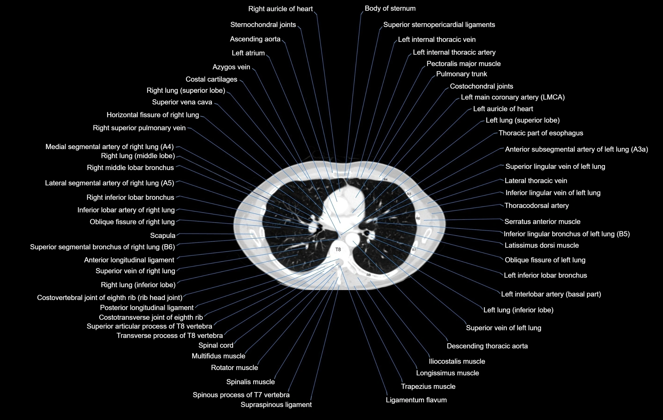 CT chest (thorax) lung window window labelled axial cross sectional anatomy radiology image-00063.webp